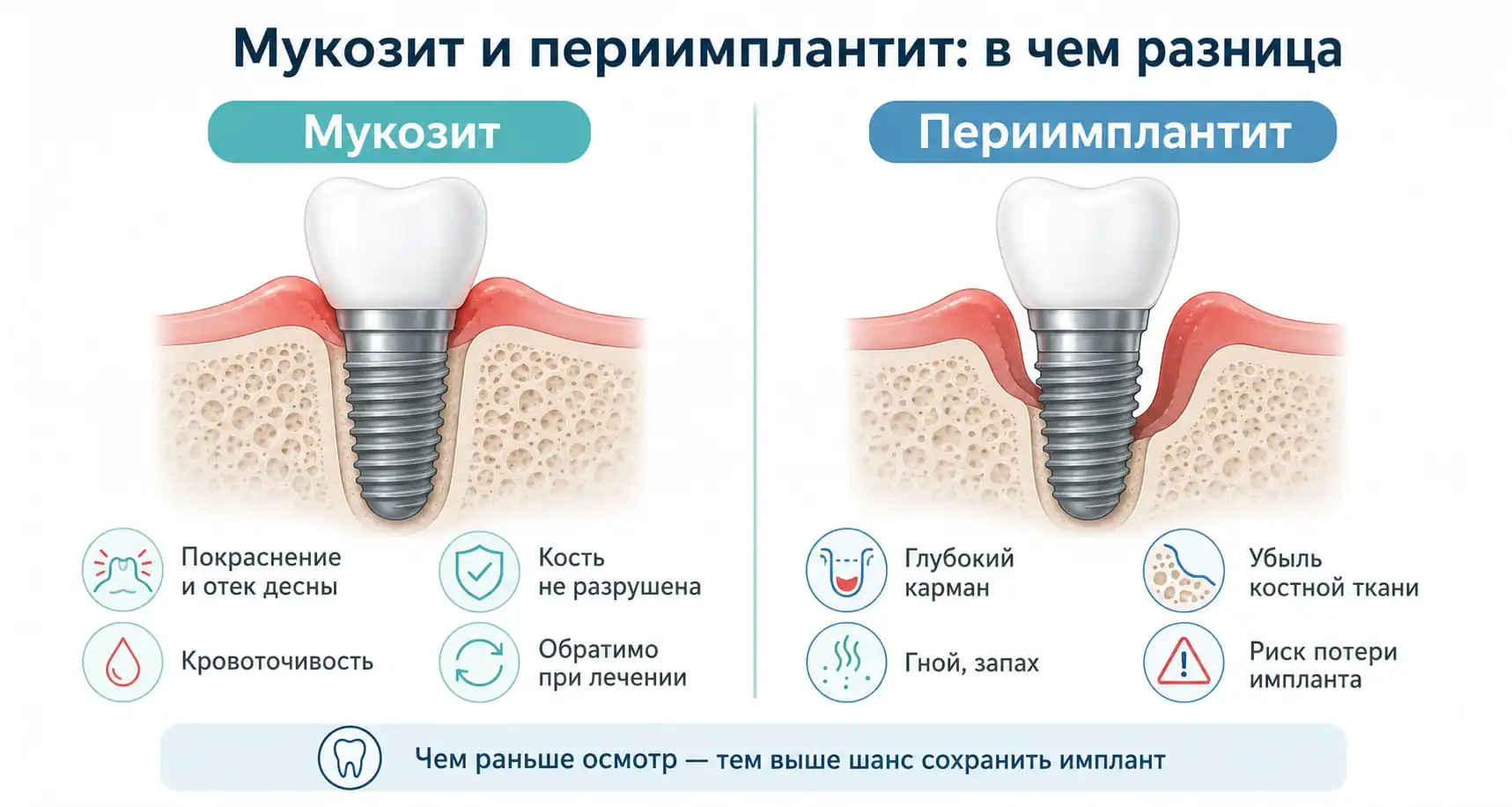Отличия мукозита от периимплантита: воспаление десны и убыль кости вокруг зубного импланта