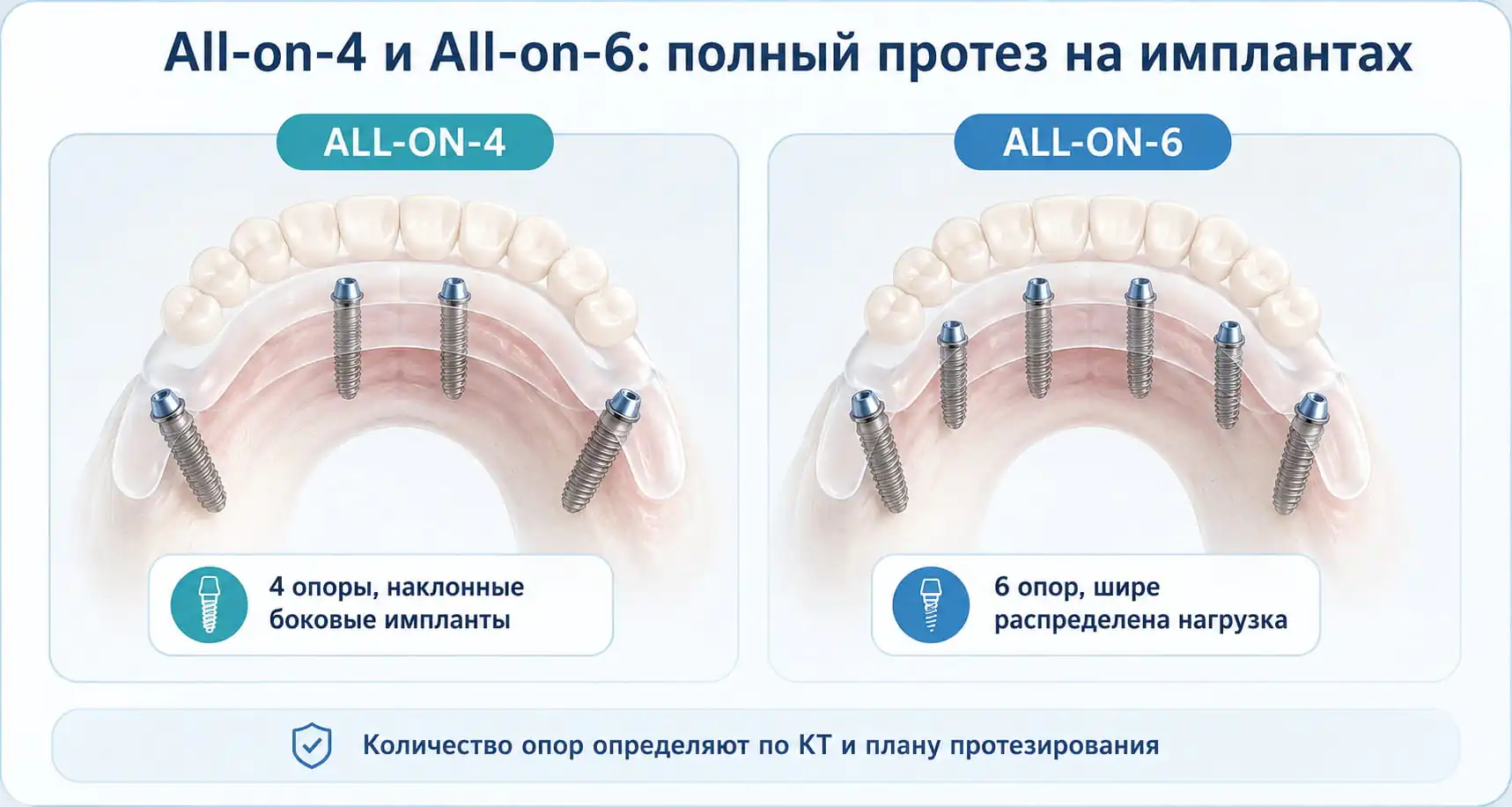 Схема протоколов All-on-4 и All-on-6: полный протез челюсти на 4 или 6 имплантах